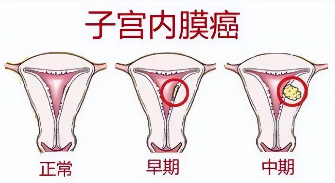 致命真相，月经不调背后的癌症晚期惊人转折揭示