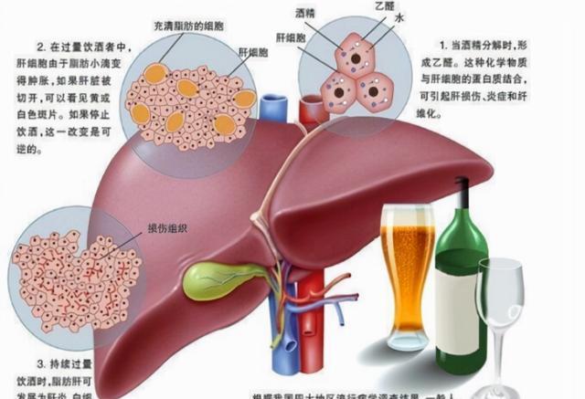 男子因过度职场应酬饮酒致肝衰竭，健康危机敲响警钟