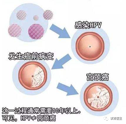 HPV感染，多数人的自然康复过程