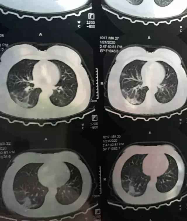 流感自救黄金48小时，关键知识助你守护健康