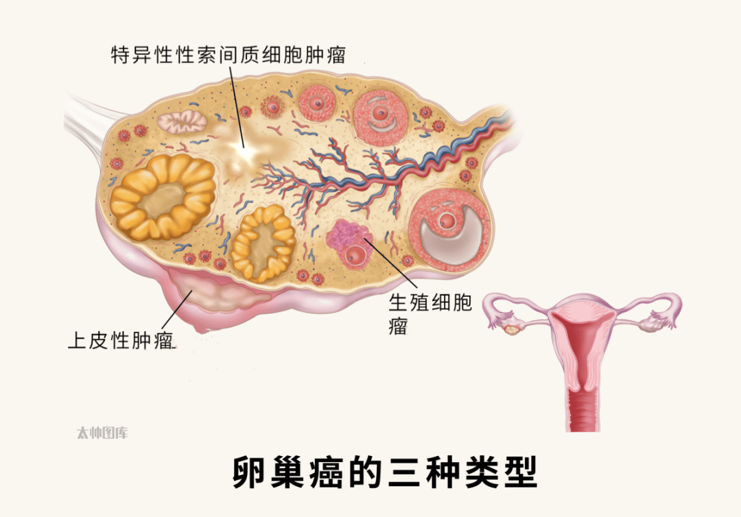 未婚女子患卵巢癌，挑战与希望并存