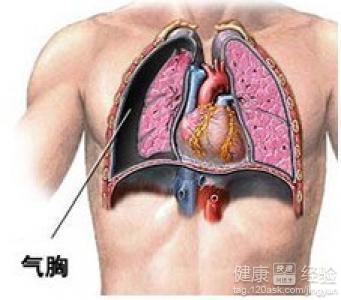 气胸详解，了解、应对及预防措施